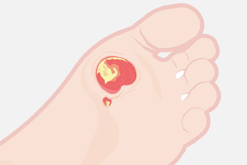 Diabetic Foot Management in pimple nilakh