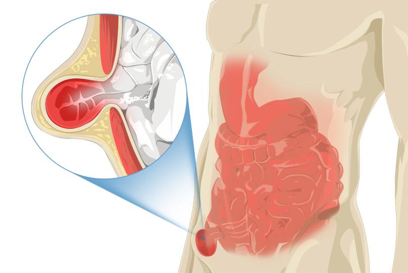 Hernia specialist in pimple nilakh