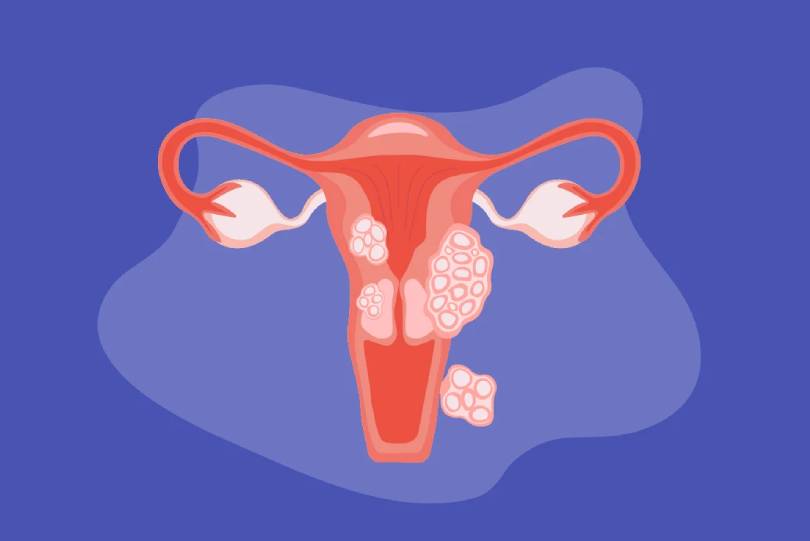 Uterine Fibroids in pimple nilakh